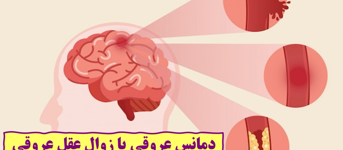 دکتر زوال عقل (دمانس) عروقی